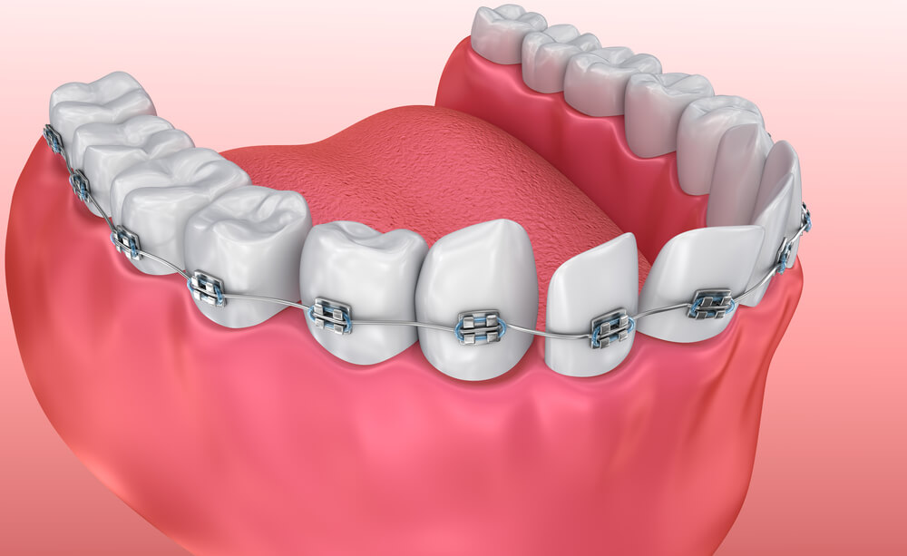 Krzywe zęby – problem nie tylko estetyczny